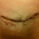 Almost 7 weeks post op - back to the wet to dry dressing for another week.