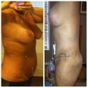 Before and 2 weeks post op