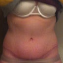 4 months PO. (Sorry for TMI, but my lower belly is bloated from PMS)