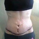 day 13 post op. still covered in sticky stuff that wont come off