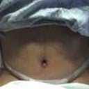 Day after my surgery