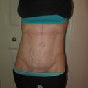 8 Months Post-Op...results look even better in person!  Vein kind of stands out with the flash!