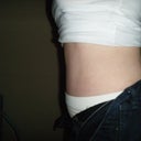 After:  Two months post op