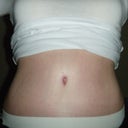 After:  Two months post op