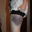 Bruising Day 2