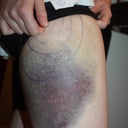 Bruising Day 2