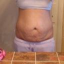 before surgery after my 2nd child though not my 3rd.