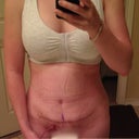 3 Days PO- the last day for a drain!  A lot of swelling around my scar...I wasn't expecting to see staples.  :S