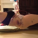 Post op day 1