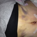 Post op day 2