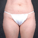 Liposuction 