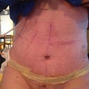 Post op day 6
