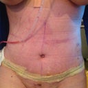 Post op day 6