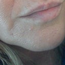 before jaw line