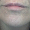 after jaw line