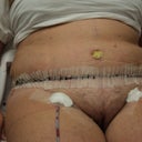 8 days post op, still have one drain in and swollen, also one side looks different than the other in this photo but in person it was even, i must have turned.