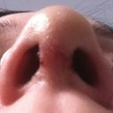 Nostrils still uneven due to swelling, but looking a bit better every day! :)