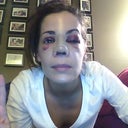 Day two. I am so swollen, one of my eyes is practically closed!