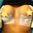 Day of surgery ~ 350CC saline mod plus profile. They are even. Look a little uneven due to me attempting to take the picture myself.