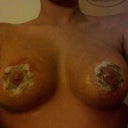 day 7! feeling little to no pain, bruising is going away, getting used to the bra, pressure still very much present, cant wait to get my stitches out in 3 days!!