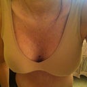 1 week post op
