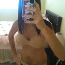 2 weeks post op - my belly is bruised and swollen