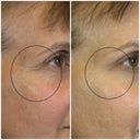 Here's a side view. The removal of these lines and the uplift of the eyelid/brow are subtle and natural--and make such a difference in my overall appearance!