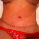 16 days post op