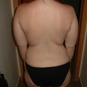Before coolsculpt
