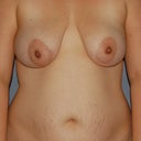 Before: Front view