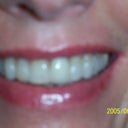 Three and a half weeks after procedure. I'm wearing lip gloss but no makeup on face or around lips. A common side effect...I can see a little bit of a gray smudge under the skin in certain light. It's visible in this photo, in fact. For me, no biggie.