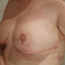19 days post op