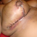 1 day post op