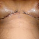 1 day post op
