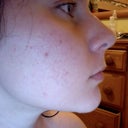 initial right cheek