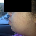 This was the morning of surgery, on my way to the surgery center! My doctor called me that he could see me earlier so I left without a proper pre-op pic near a wall!