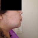 This is a couple after hours after the surgery was performed.  Chin Augmentation and neck liposuction!