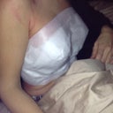 3 hours post op BA! So much pain!!! Ugh!
