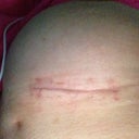 Incision as of today! Still have to keep steri strips on this one right side with having second surgery and trauma to this breast ugh! I would never do it again... My luck sucks!