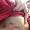This is day after second surgery now have drain that was the worst pain ever!