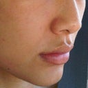 after filler