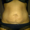 before surgery