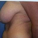 Side view pre-op