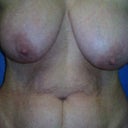 Pre- op