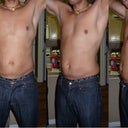 Preop #1, the day prior to the surgery.