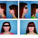 Before and after, nose and chin