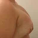 Right side post op day 7 (smaller breast before)