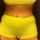 This is what I look like in the mornings. 3 weeks post op