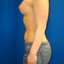Two weeks. Post op. just took off tape.