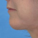 Female Chin Implant 